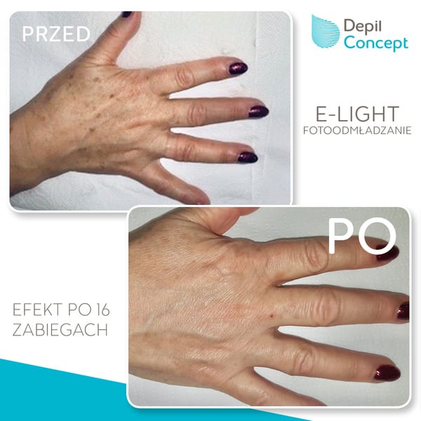 fotoodmładzanie dłoni e-light regeneracja dłoni 